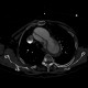 Aortic dissection, Stanford A, hemopericard: CT - Computed tomography